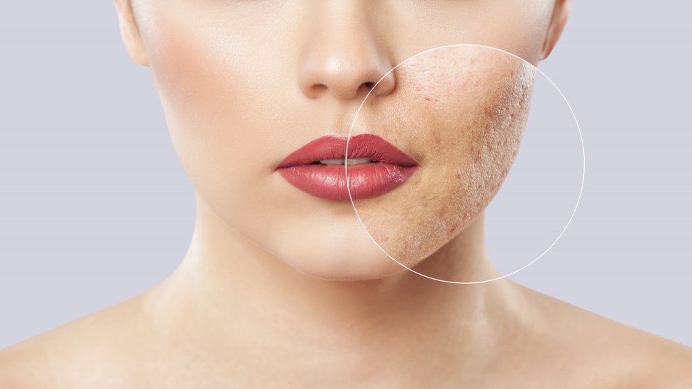 What is cystic acne and what causes it?